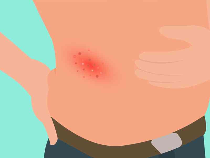 单纯孢疹病毒一般都表现为皮肤疱疹