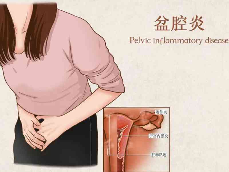 宫颈炎可能导致盆腔炎发生