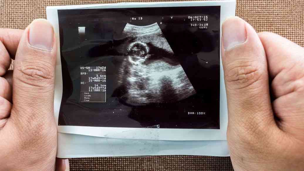 孕囊形状 男孩图片