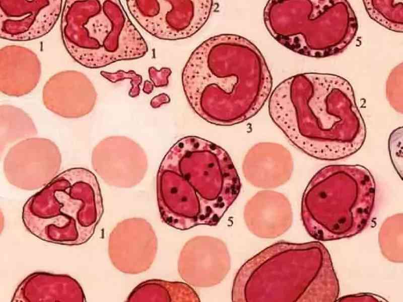 慢性粒细胞性白血病会导致血小板增高