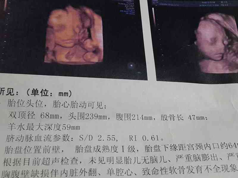 三维彩超能显示胎儿成长过程