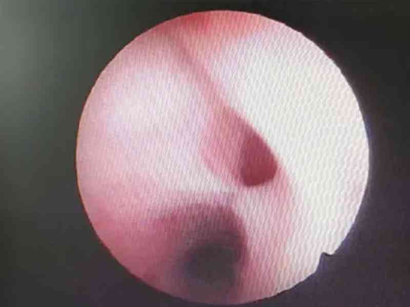 宫颈管粘连会导致排卵期出血