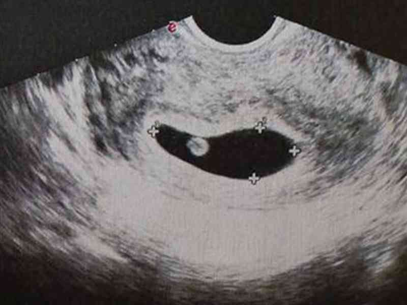 孕囊随着妊娠周期长大