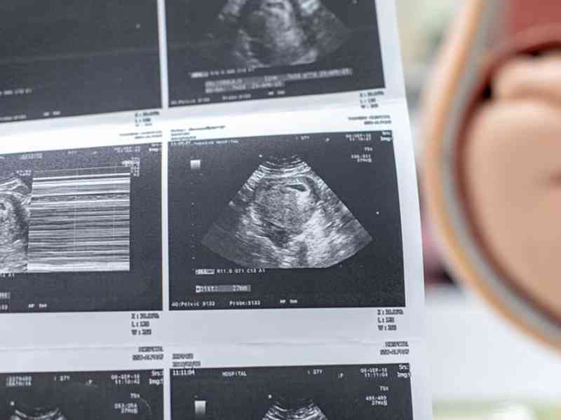 孕妇6周的孕囊已经有0.85cm
