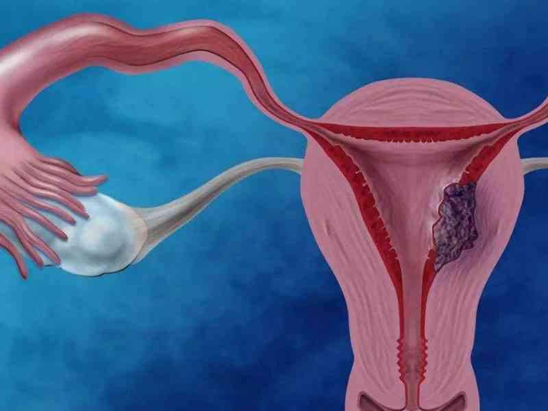 宫腔灌注能将药物送进宫颈口