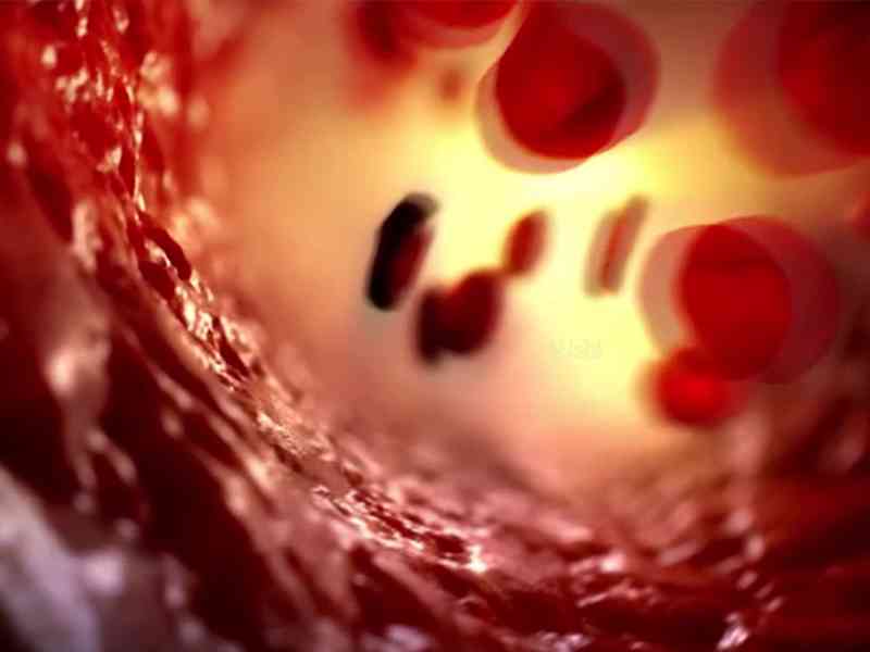 镰刀型细胞贫血症是遗传性血红蛋白病