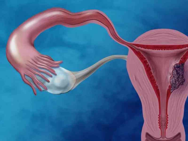 基础体温能提示可能患有子宫内膜异位症