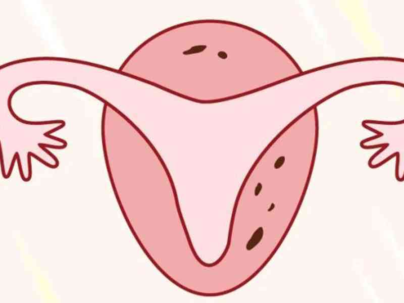 输卵管发育不良也是输卵管不孕类型的一种