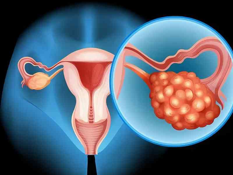 卵巢性不孕可能是因为卵巢肿瘤