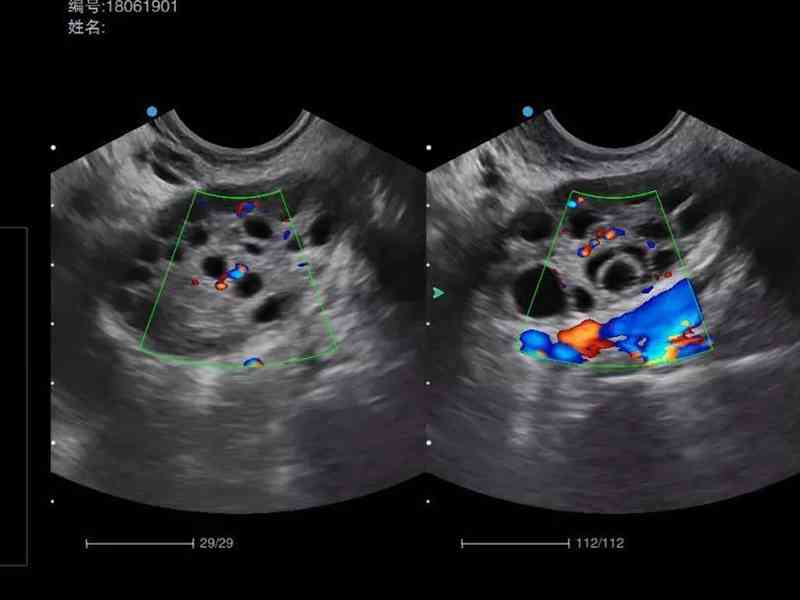 卵巢性不孕可以通过腹腔镜手术治疗