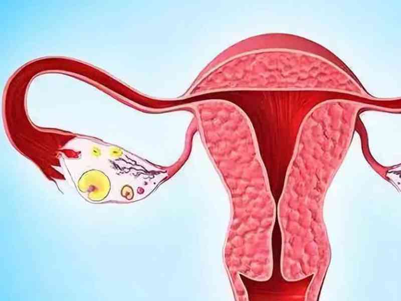 宫颈管位置异常可能导致宫颈性不孕