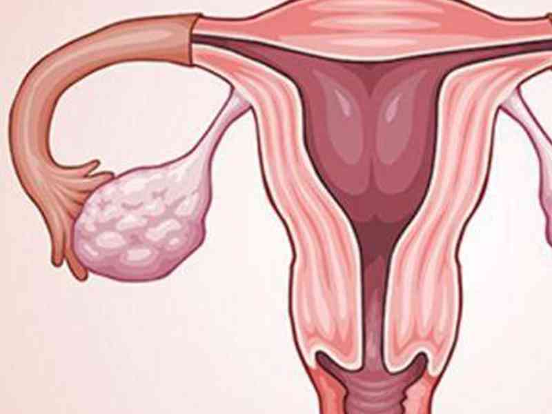 子宫性不孕 - 引起原因、检查项目、治疗方法与费用大全