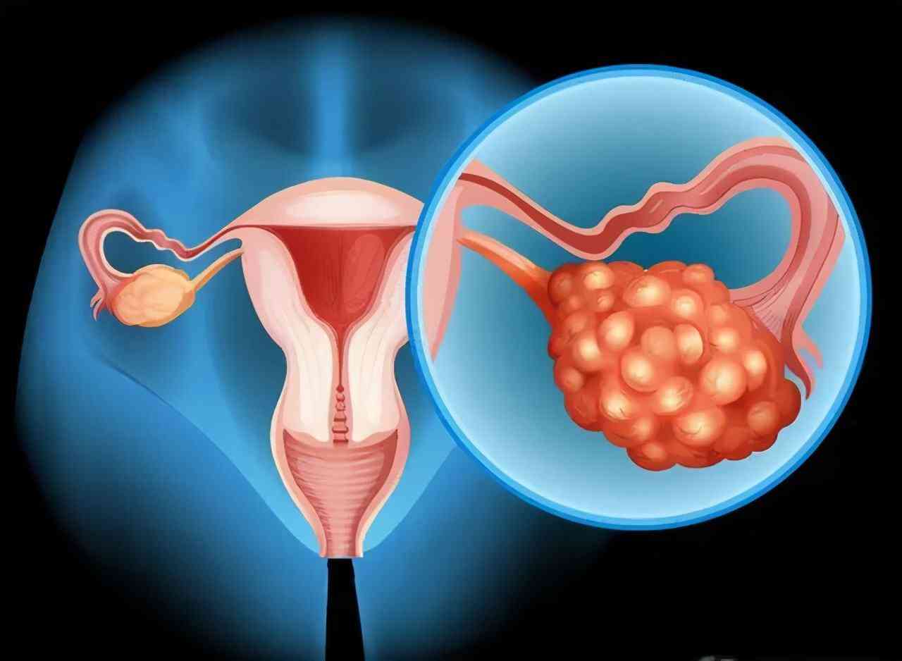 卵巢可能导致不孕