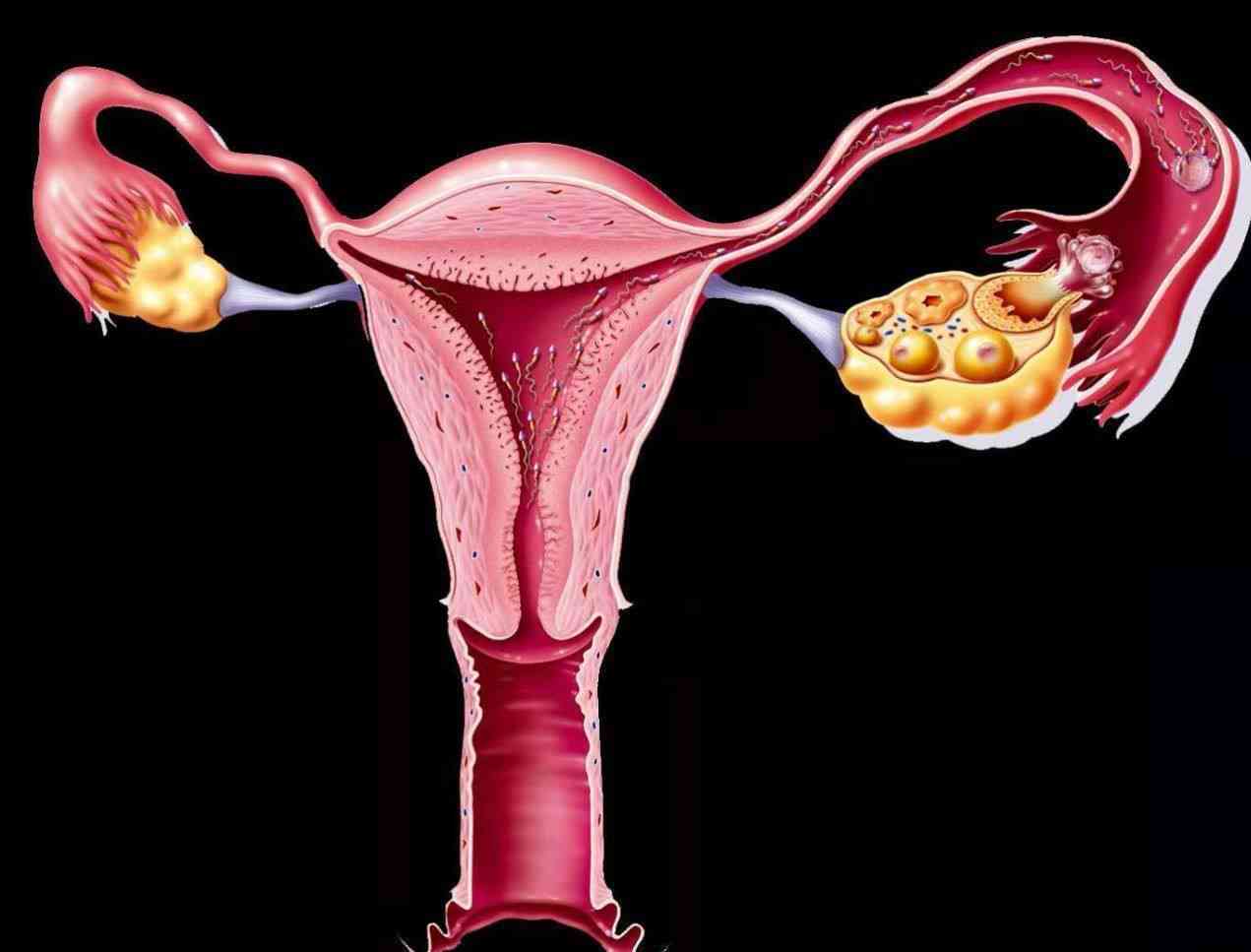 输卵管堵塞可能导致不排卵不孕