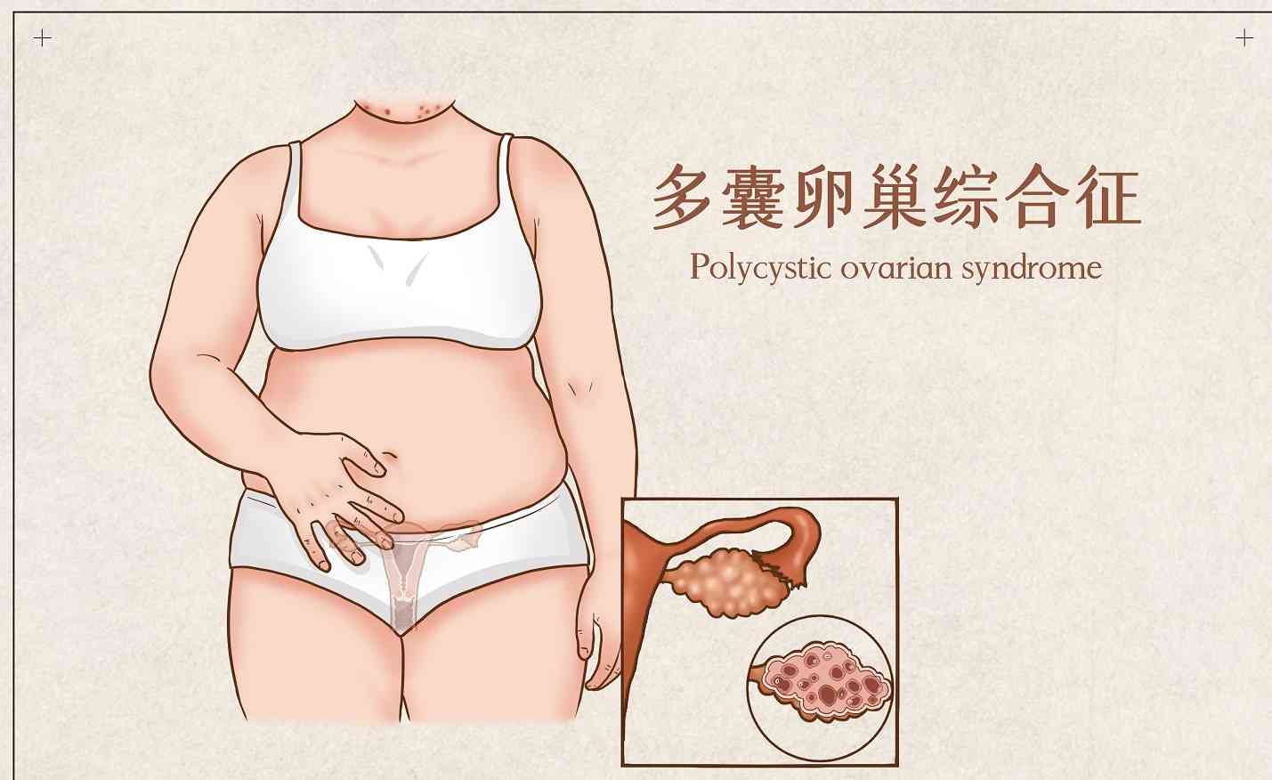 多囊卵巢综合征可能导致不排卵不孕