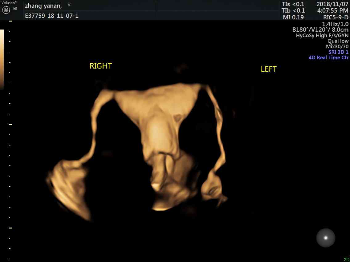 子宫输卵管超声造影次月即可怀孕