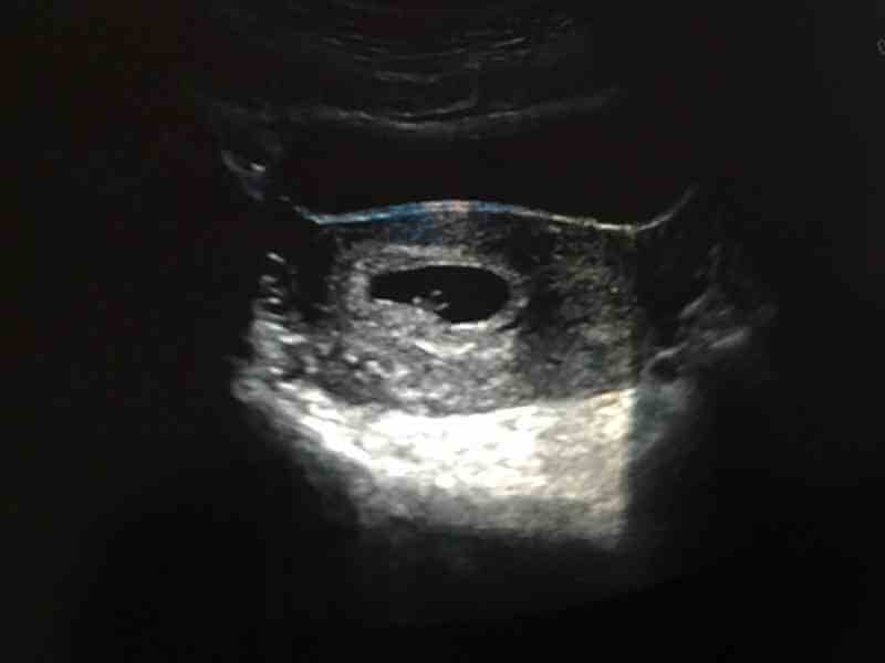 怀孕4周孕囊大小约为10.6mm