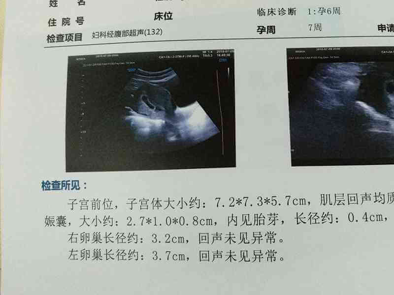 孕囊大小与孕周对照表公式准确看出胎儿发育情况