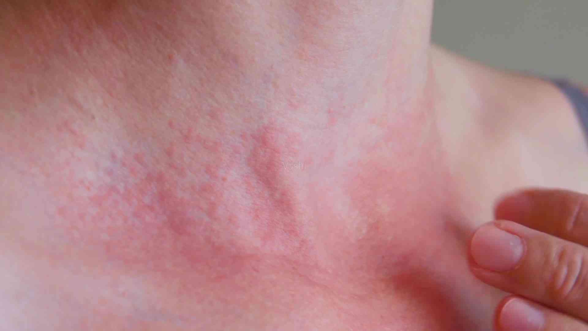 部分女性接种疫苗后可能会出现皮疹