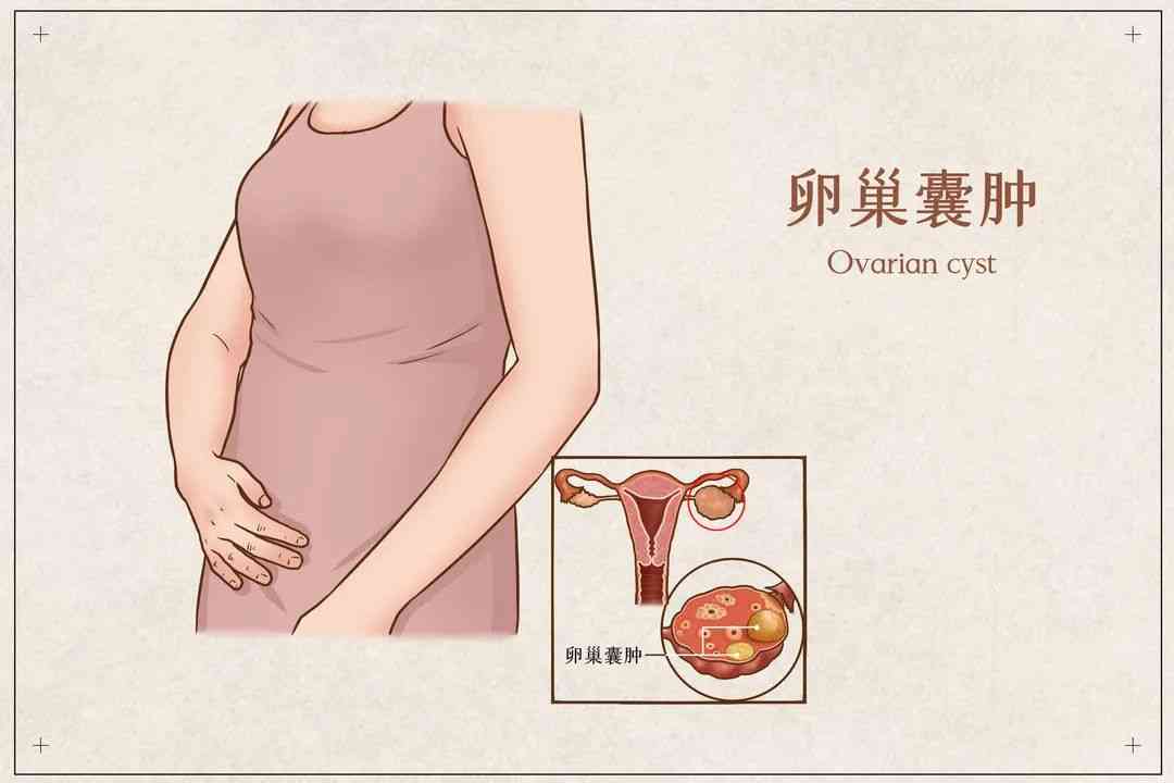 卵巢囊肿对怀孕的影响很大