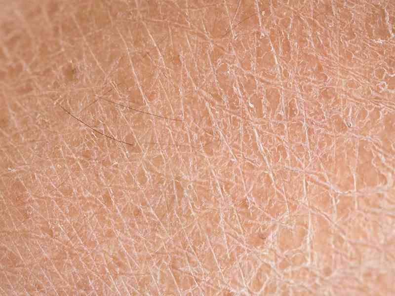 缺乏维生素a会出现皮肤干燥的现象
