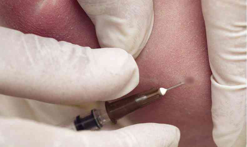 接种水痘疫苗后可能出现局部红肿