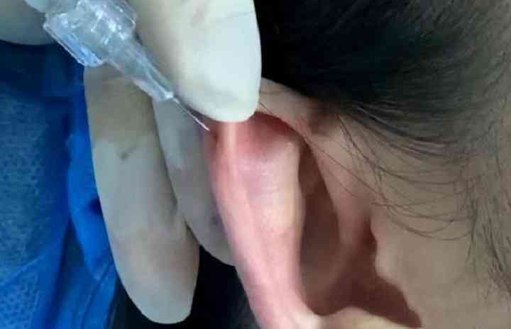 精灵耳手术