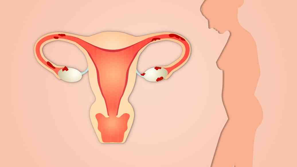 子宫异常容易在8到10周胎停