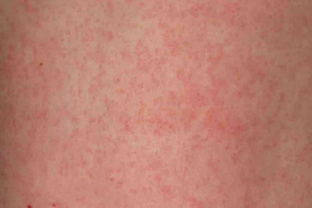 孕妇全身皮肤痒可能是因为皮疹