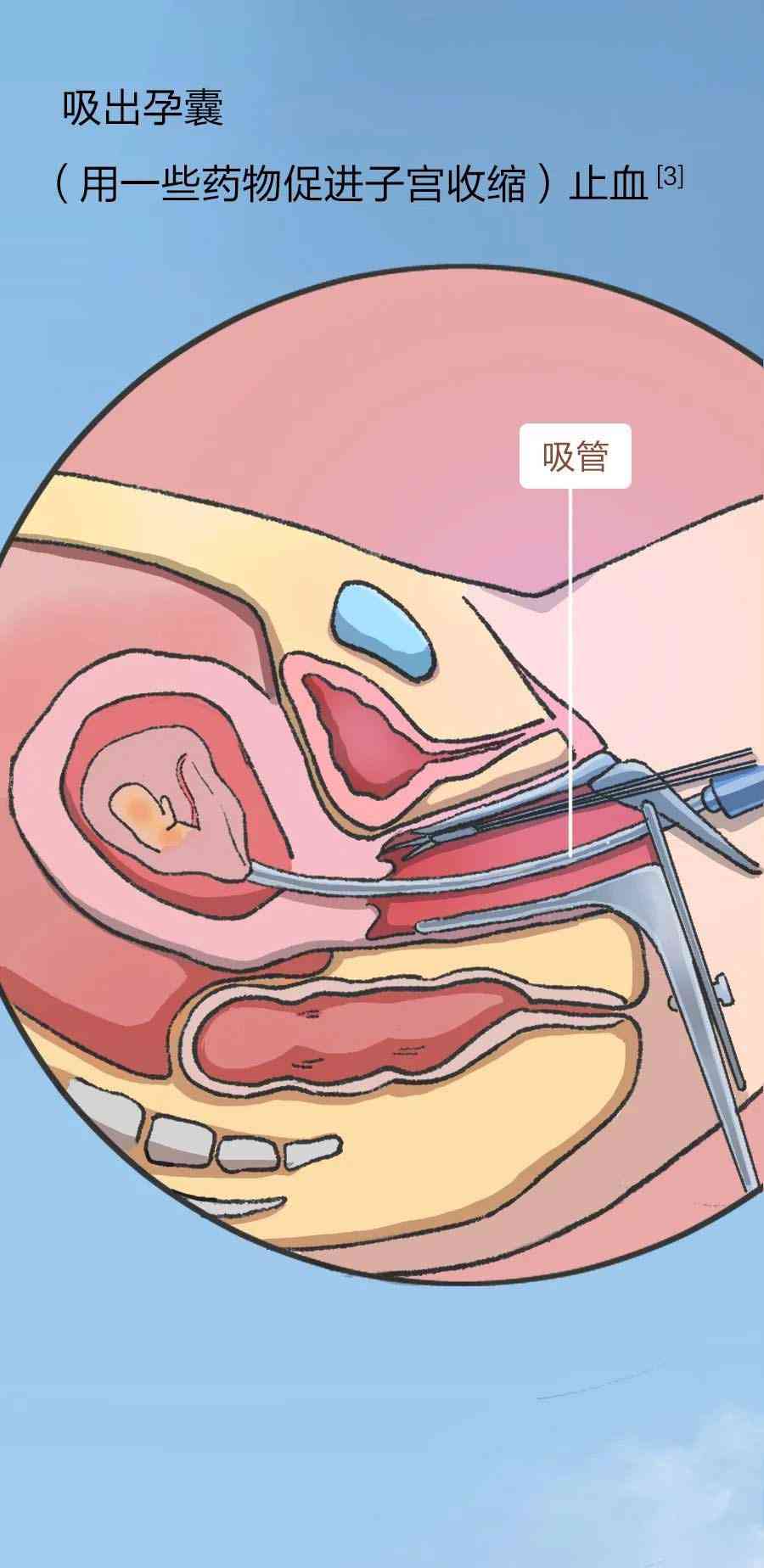 人流手術具體流程