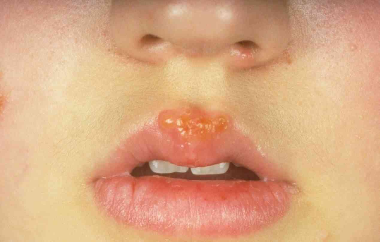 孕妇嘴角长疱疹很常见