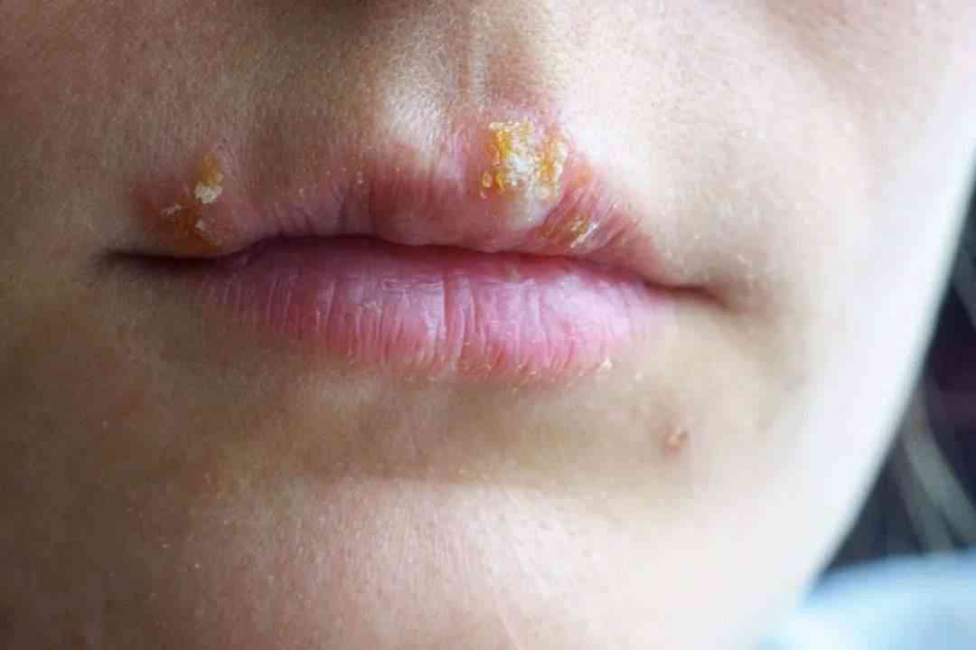 孕妇嘴唇上长疱疹可能会自愈