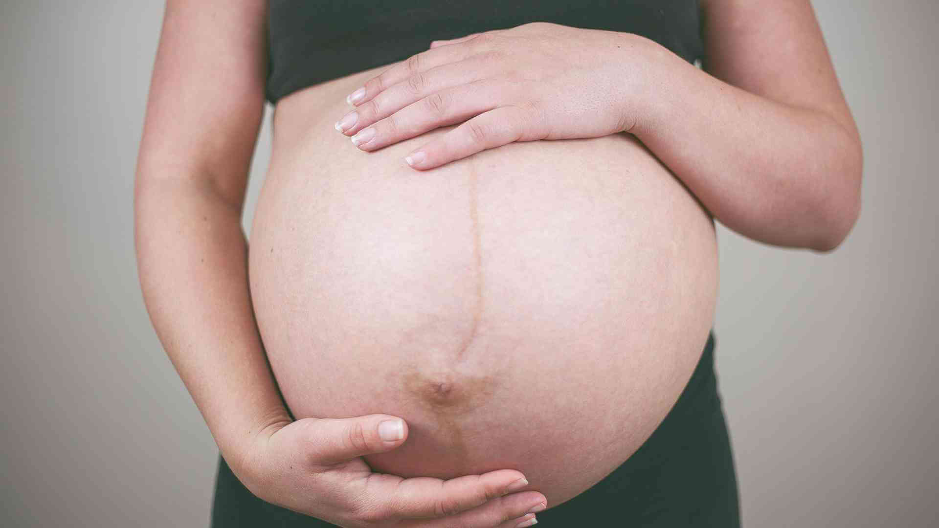 女性怀孕后会有妊娠线