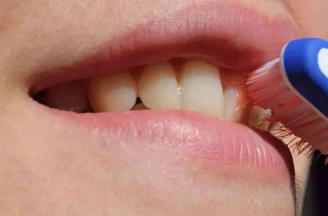 孕妇牙龈出血可能缺乏维生素