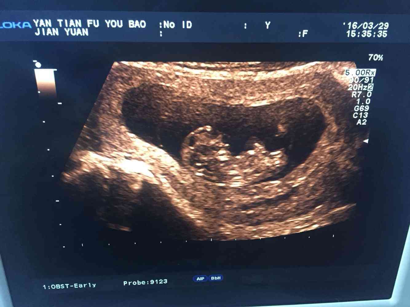 酒精测试胎儿性别图片图片