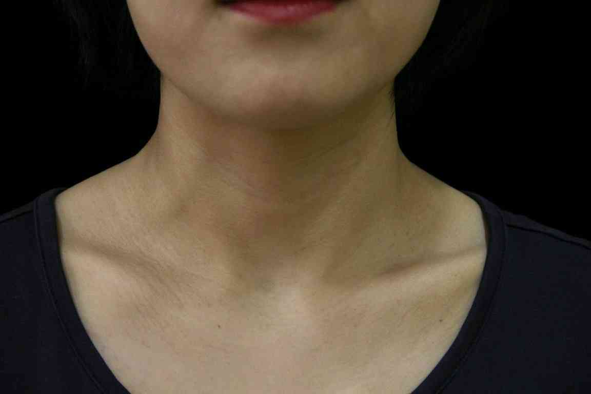 颈部脂肪堆积过多会产生颈纹