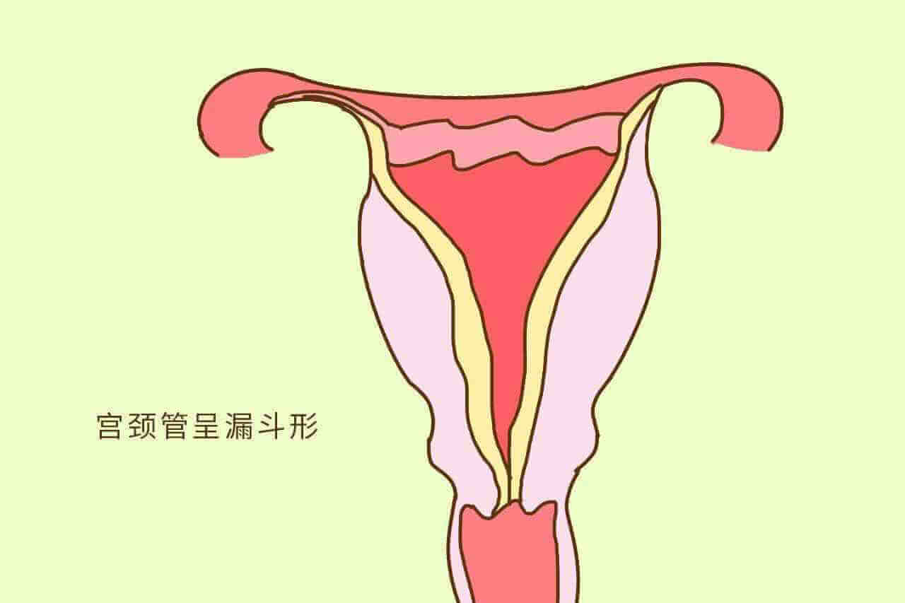 宫颈短居然长上去了这才是宫颈管短保胎到足月的成功秘诀