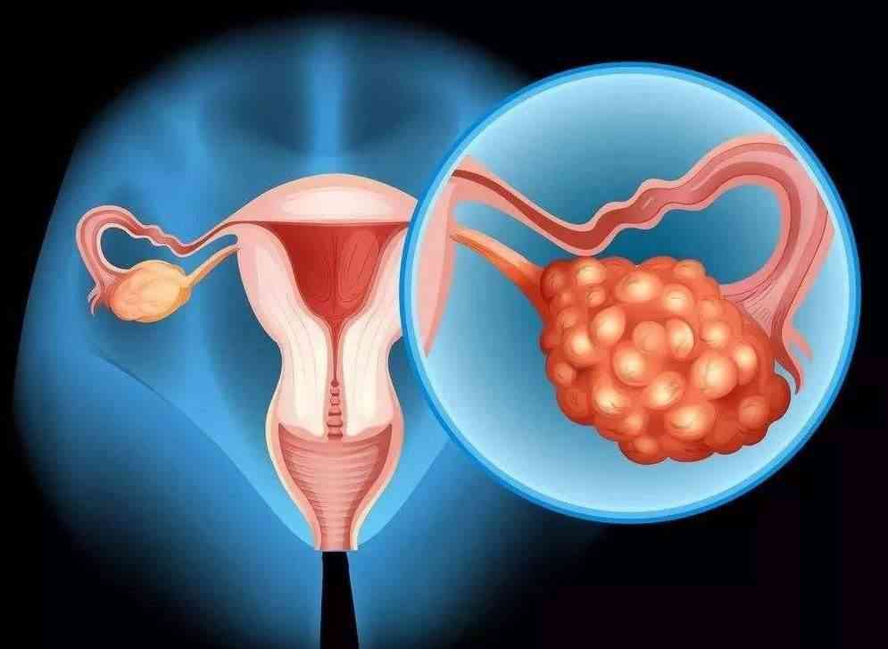 多囊卵巢是内分泌兼代谢性疾病