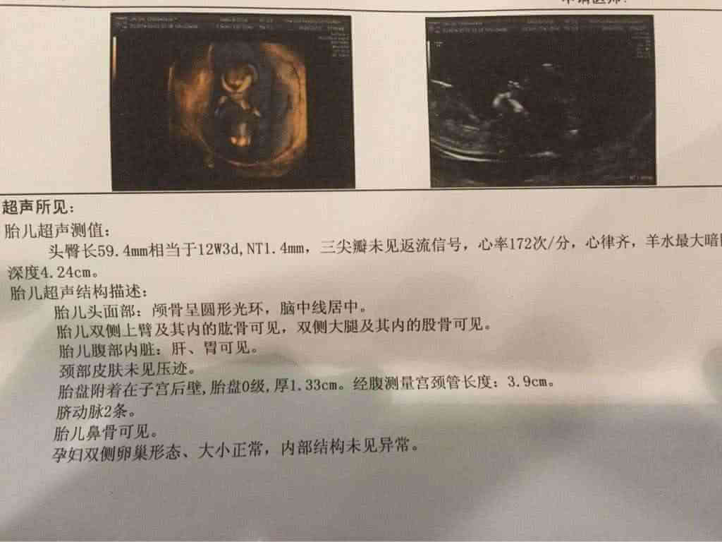 13周已生男寶的nt單子原來男孩的nt圖片有圈圈