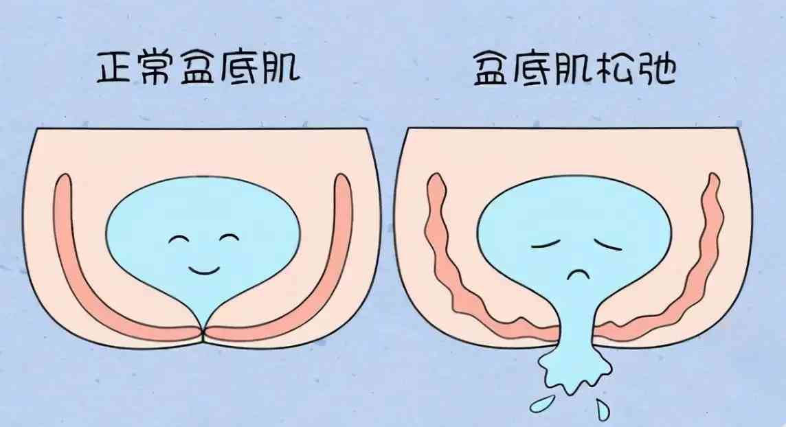 顺产女性盆底肌松弛会比较严重