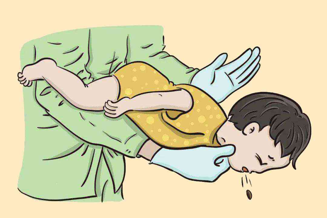 海姆立克急救法超详细教学