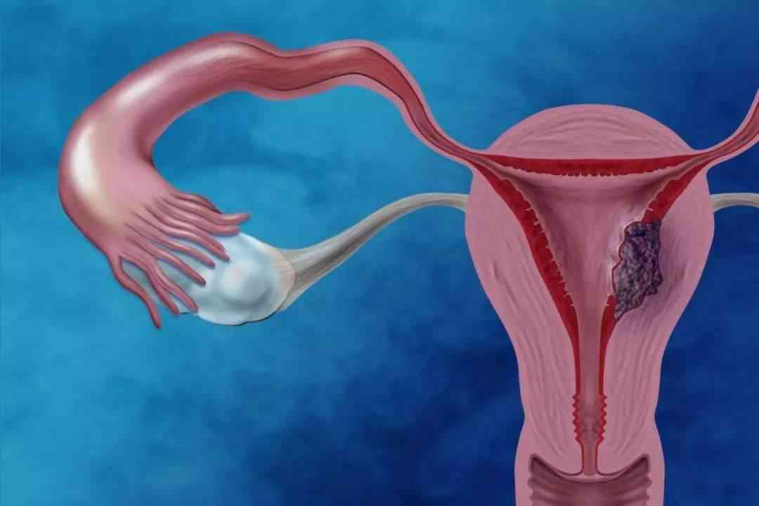 卵巢早衰可能会导致不孕症
