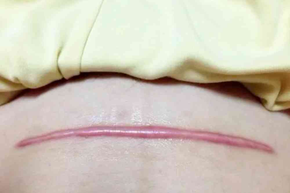 剖腹产术后会留疤