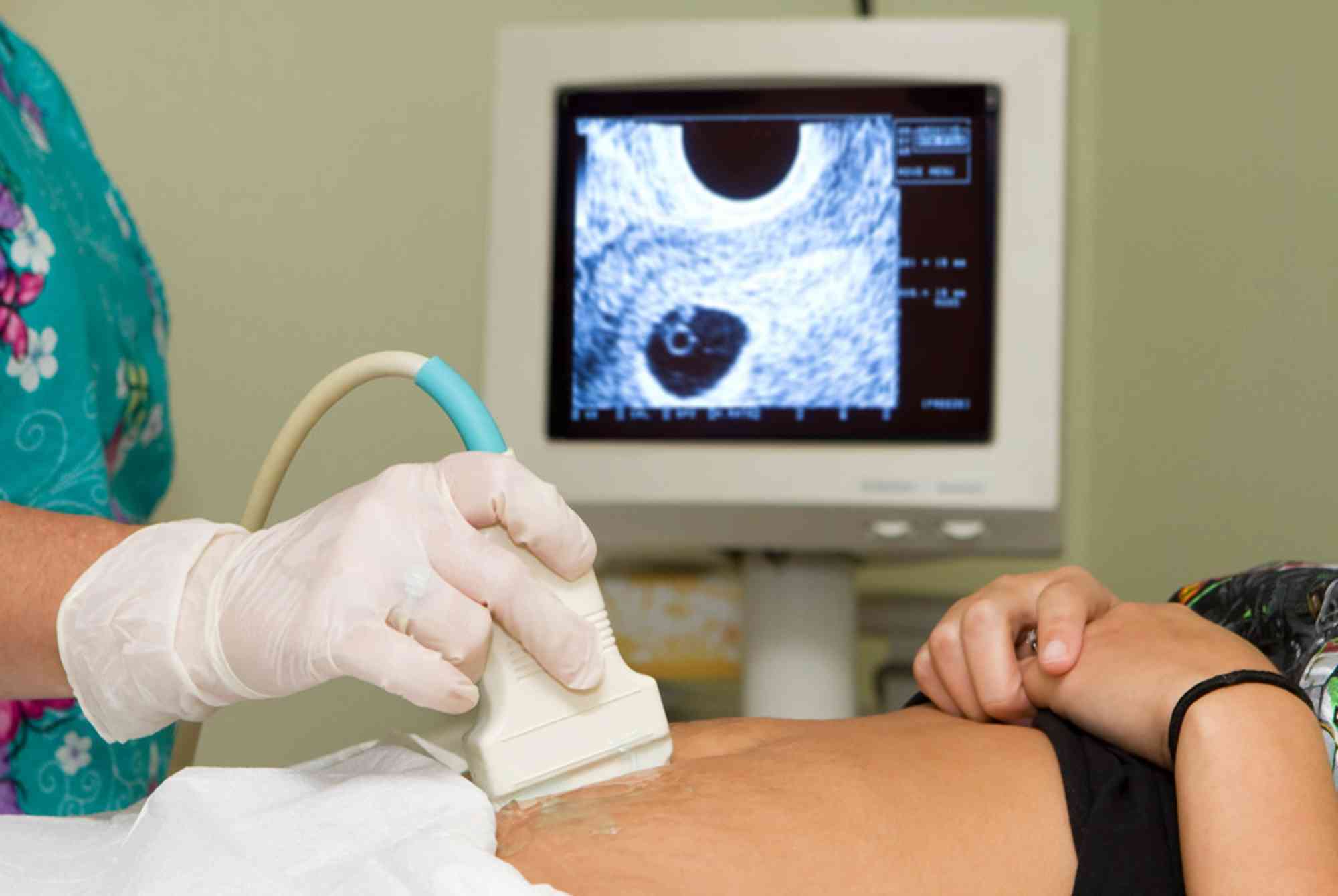 腹部B超可判断胚胎是否成功移植
