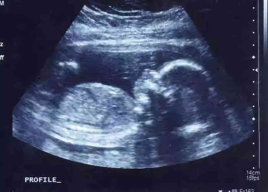 卵黄囊表示胎儿发育正常