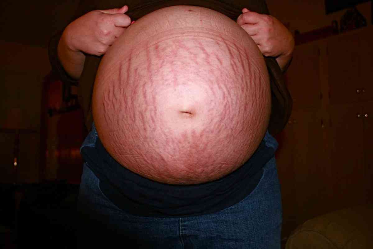 胖人更容易在怀孕后长妊娠纹