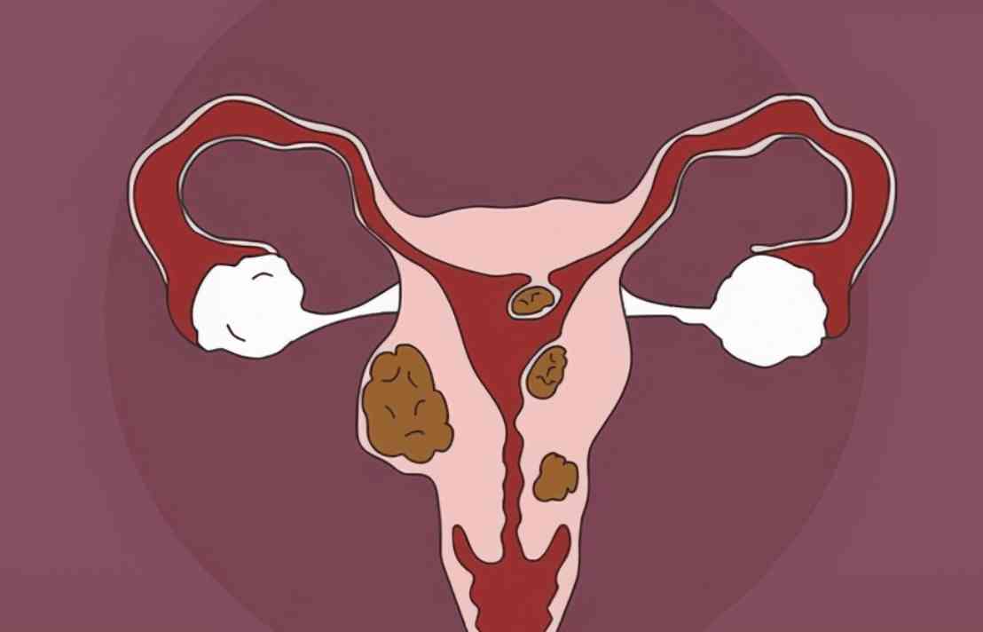 子宫肌瘤患者特别适于食用肉苁蓉