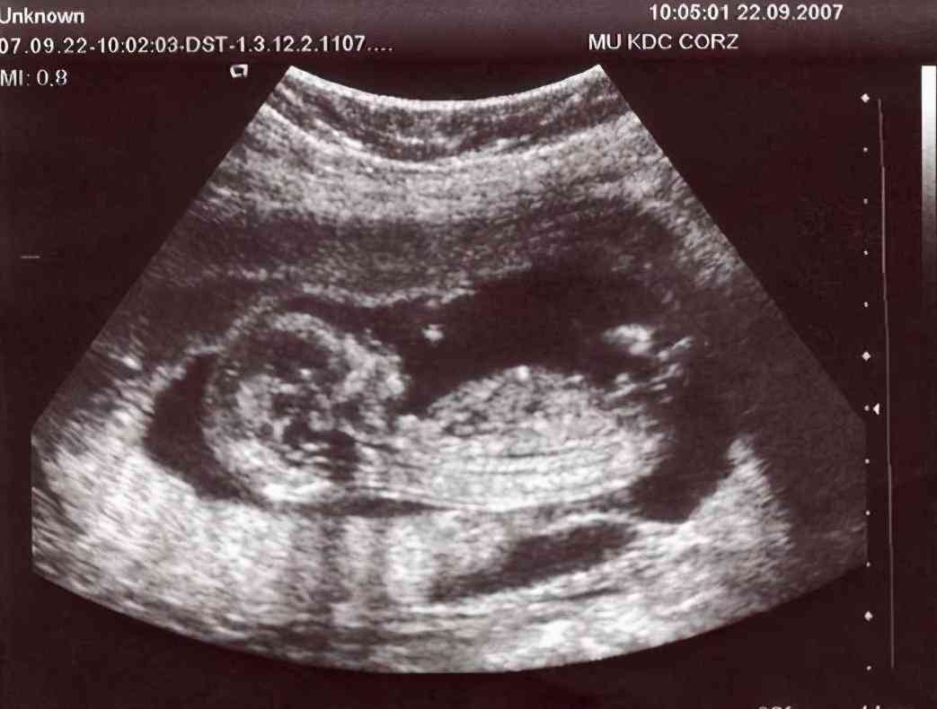 孕27周男女胎儿图片图片