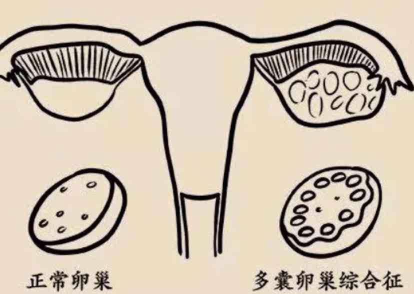 治疗多囊卵巢