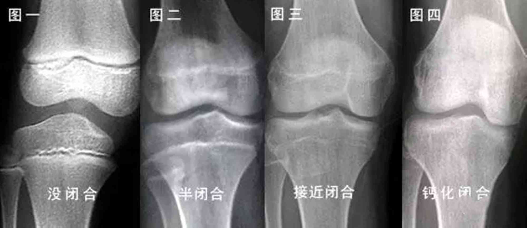 2022版10到16歲骨齡對照表男孩女孩身高都要隨時關注